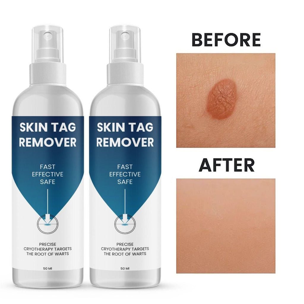 Skin Tag Remover