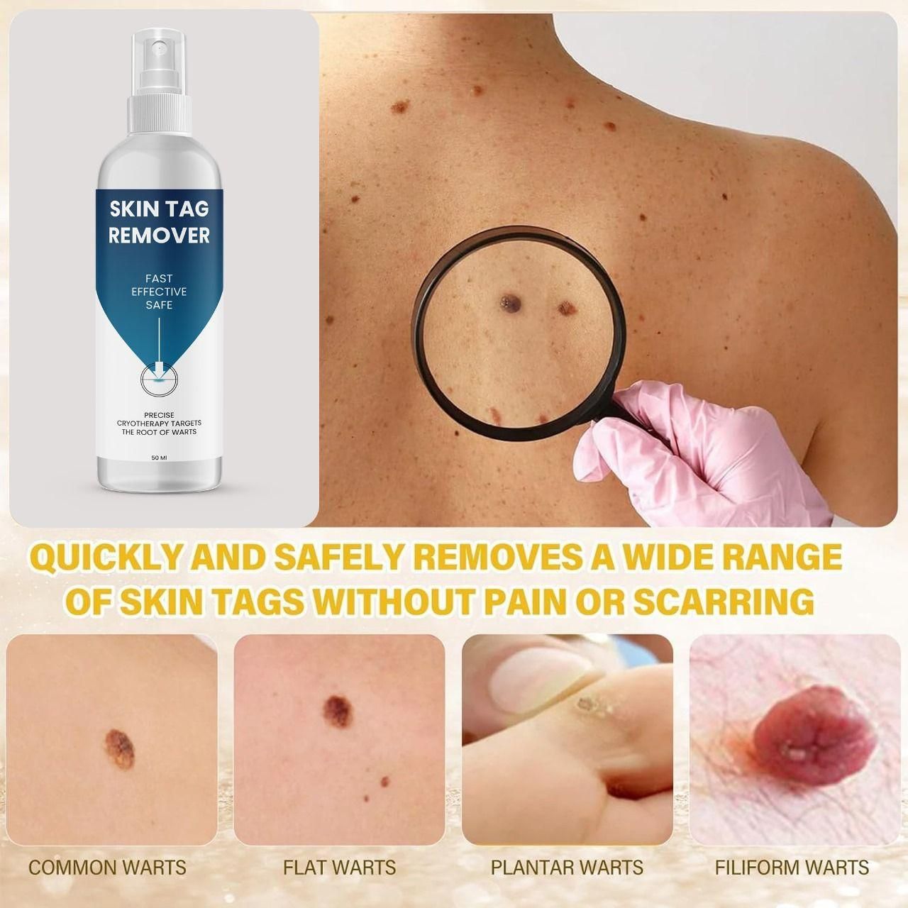 Skin Tag Remover