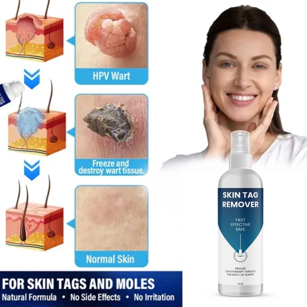 Skin Tag Remover